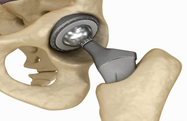 joint replacement (2)